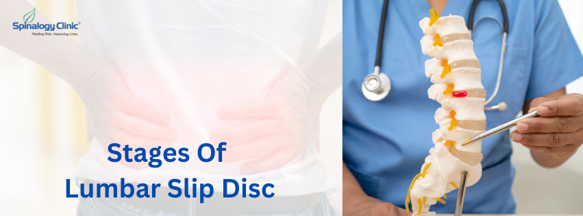 Stages Of Lumbar Slip Disc